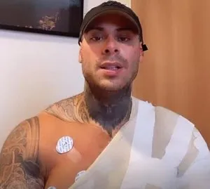 Ele teve 30% do corpo queimado 