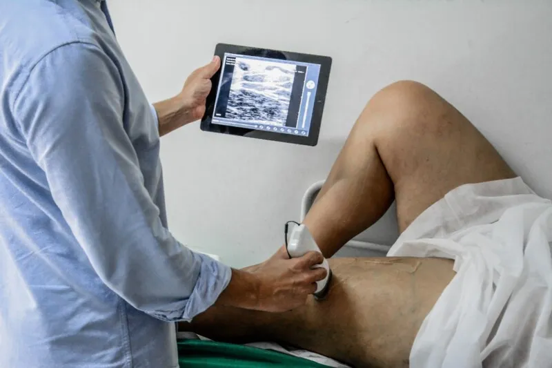 tratamento de varizes com técnica moderna sem necessidade cirúrgica em Itaboraí 
