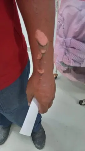 Servidor teve seu braço e rosto queimados