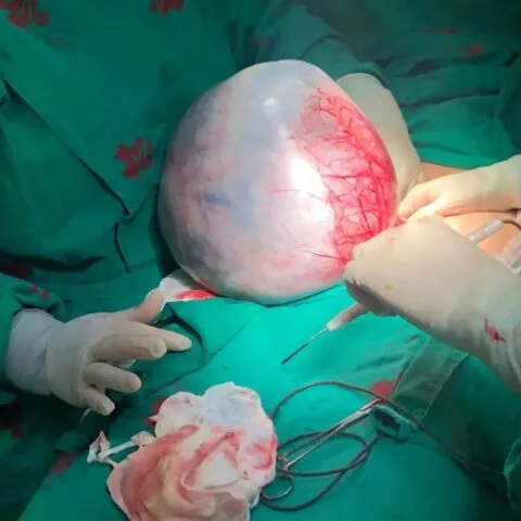 Cisto removido do ovário da paciente