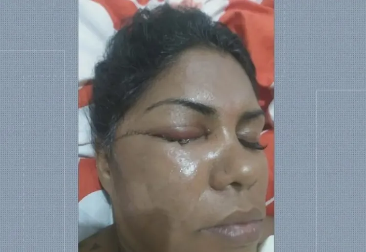 Bruna perdeu a visão do olho direito