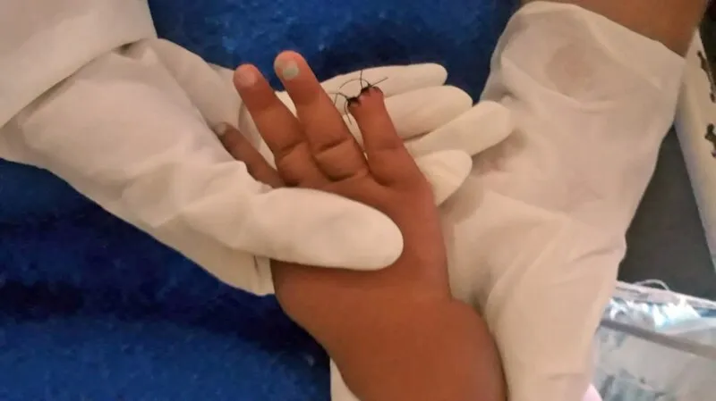 A menina precisou amputar parte do dedo mindinho por causa de um erro na hora de tirar uma atadura, onde estava um acesso venoso