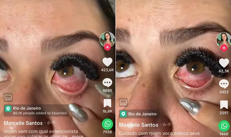 O erro durante a aplicação deixou o produto conhecido por “gel pad” encostando diretamente no globo ocular da vítima