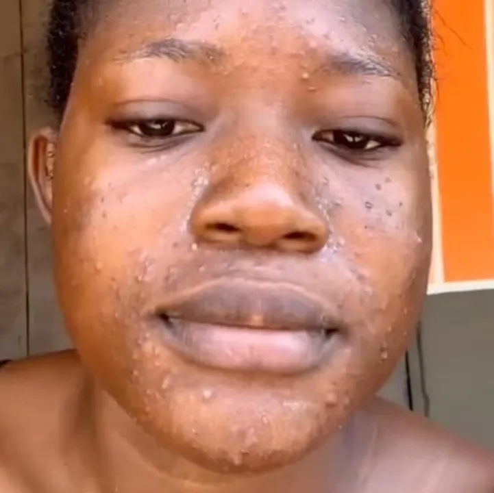 A jovem precisou ir ao hospital e chegando lá, a equipe médica prescreveu um creme de hidrocortisona para acalmar sua pele