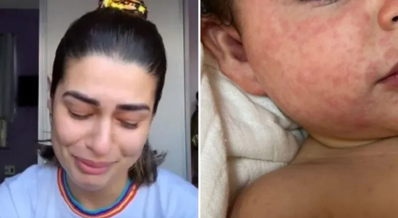 A doença viral causa febre e gera sintomas desagradáveis nas crianças