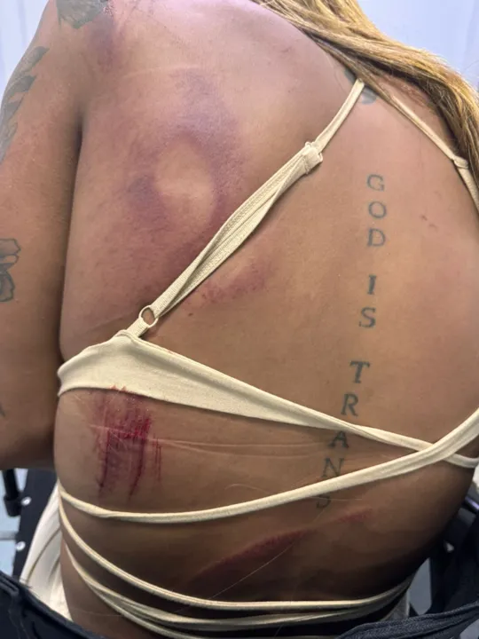 Ela ficou com vários hematomas espalhados pelo corpo