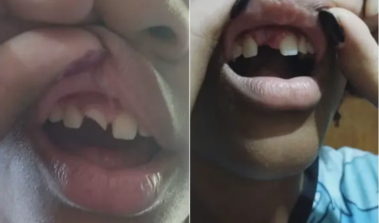 Jovem perde dente após ser agredida dentro de escola pública de São Gonçalo