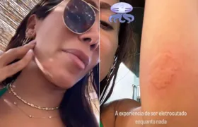 Anitta é "eletrocutada" por água-viva durante viagem à Espanha