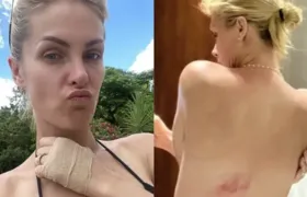 Após agressão, fãs relembram acidentes 'suspeitos' de Ana Hickmann