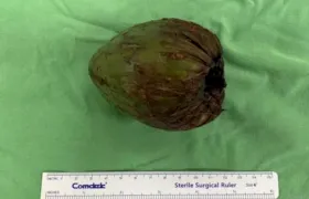 Homem é operado após inserir coco de 9cm no ânus