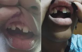 Menina de 14 anos perde dente após agressão em escola de São Gonçalo