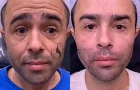 Motorista que atropelou Kayky Brito faz harmonização facial