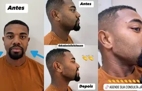 Davi Brito exibe resultado de harmonização facial