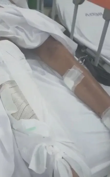 o jovem sofreu uma fratura exposta em uma das pernas e ferimentos na outra