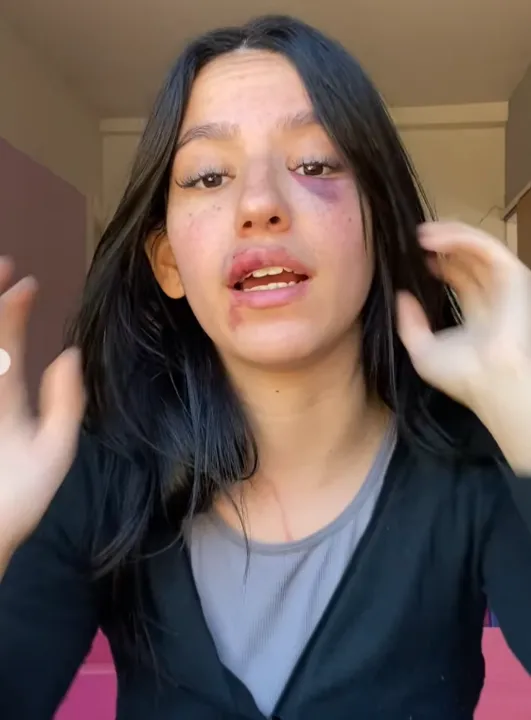 Registros divulgados nas redes sociais mostram marcas das agressões sofridas pela aluna