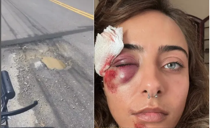 Acidente que aconteceu no último domingo (19), deixou a jovem impossibilitada de trabalhar