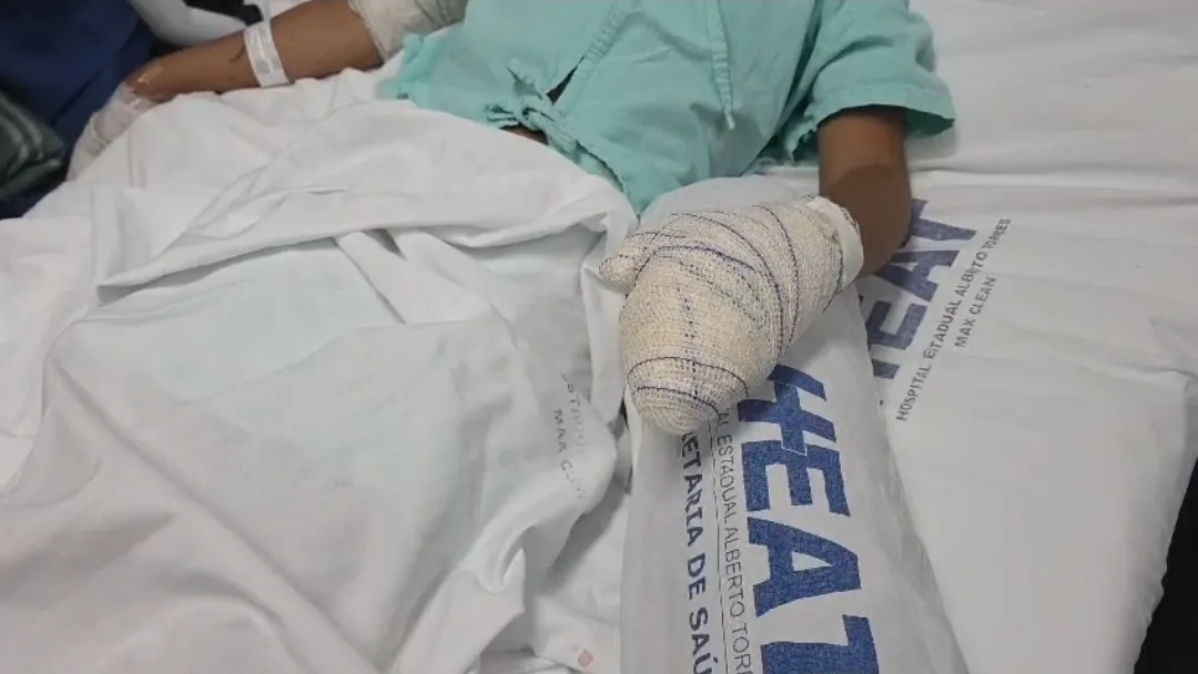 Ao menos cinco menores de idade tiveram amputações de dedos por uso de fogos