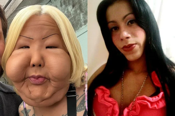 'Juju do Pix' teve o rosto deformado após procedimento estético em uma clínica clandestina