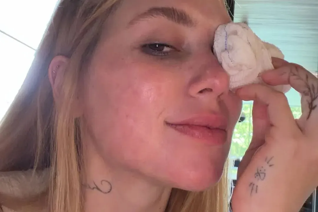 Virginia mostra ferimento no olho