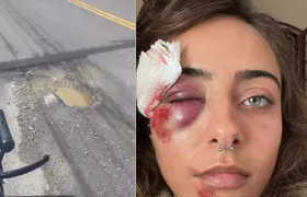 Buraco em via com má iluminação causa acidente e deixa jovem com rosto desfigurado em Niterói