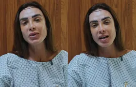 Nicole Bahls fez transplante capilar após ter alopecia androgenética
