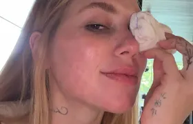 Virginia Fonseca sofre acidente e tem lesão no olho