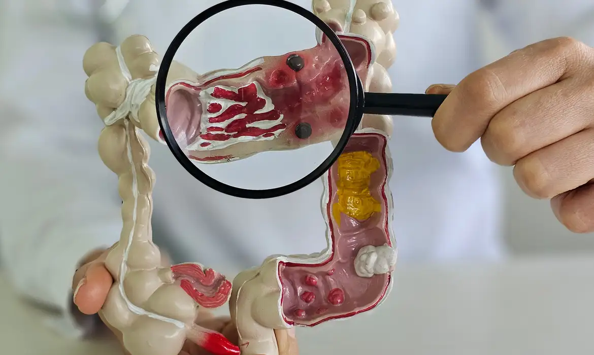 O dado é de um estudo apresentado no 74º Congresso Brasileiro de Coloproctologia