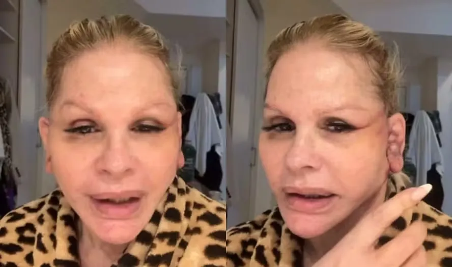 Em vídeos publicados nas redes sociais nesse domingo (2), Monique mostrou como está a recuperação