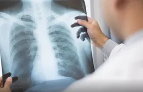 Anvisa aprova novo medicamento para câncer de pulmão avançado
