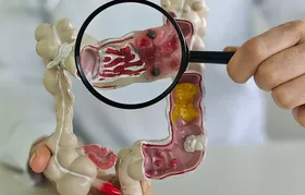 Em 13 anos, doença inflamatória intestinal cresce 5 vezes no Brasil