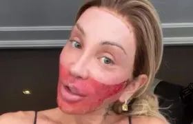 Maya Massafera volta a aparecer com rosto queimado e explica situação