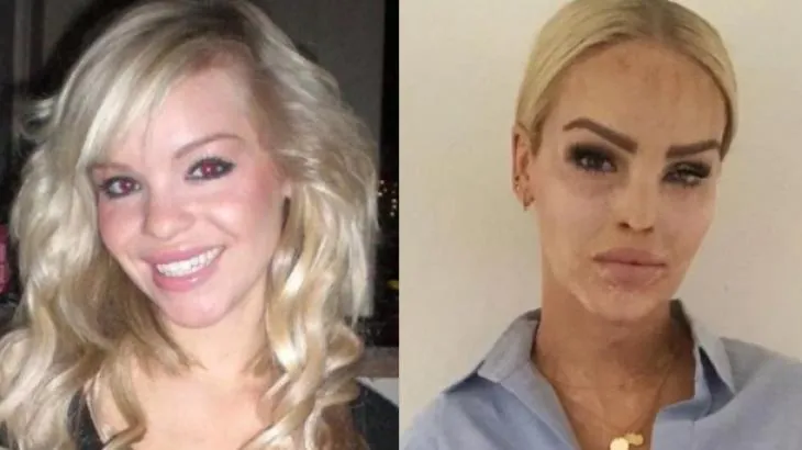 A apresentadora Katie Piper teve que passar por 400 cirurgias após ataque do ex-namorado