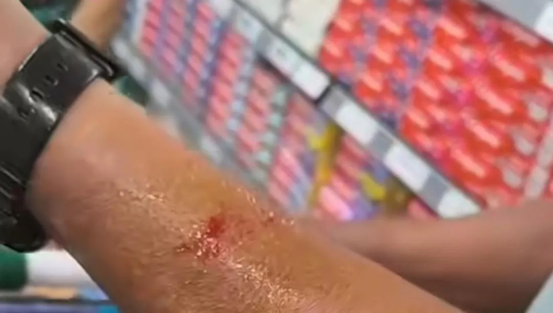As imagens, embora não mostrem o momento exato do incidente, revelam o braço do consumidor sangrando