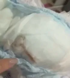 O animal estava embaixo da primeira camada de tecido da fralda