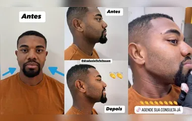 Davi Brito exibe resultado de harmonização facial