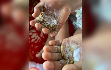 Mulher é presa por queimar as mãos da própria filha, de 9 anos, por reclamar de fome