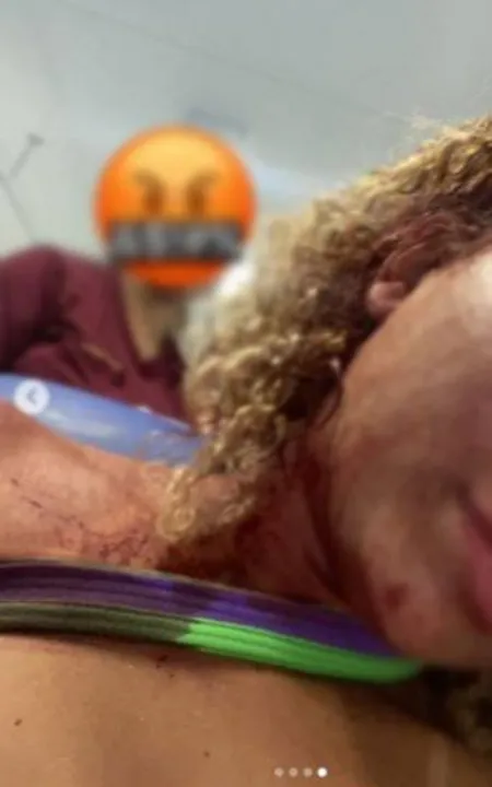 Em meio às ofensas, a jovem relatou que entrou no carro de aplicativo, mas o homem a retirou de lá e a agrediu na cabeça com muletas