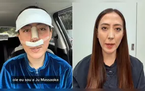 Caso Ju Massaoka: Conselho Federal de Medicina proíbe uso de PMMA em procedimentos estéticos; entenda!