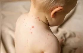 Sarampo volta a preocupar autoridades nas Américas e reforça alerta sobre vacinação infantil