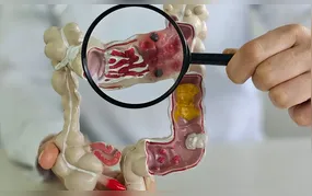 Em 13 anos, doença inflamatória intestinal cresce 5 vezes no Brasil