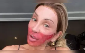 Maya Massafera volta a aparecer com rosto queimado e explica situação