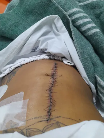 A jovem teve que passar por uma cirurgia