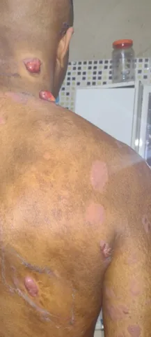 O câncer de Gilmar faz com que ele tenha feridas pelo corpo