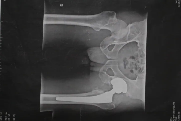 Imagem ilustrativa da imagem Gonçalense aguarda há dois anos, na cama, por cirurgia na perna