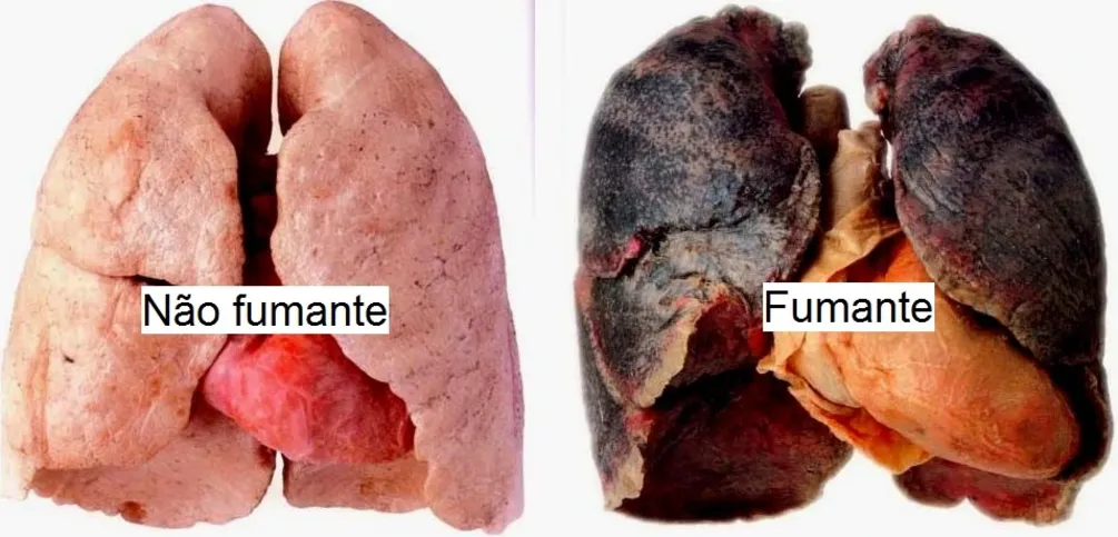 Imagem ilustrativa da imagem 'Agosto branco' alerta para câncer de pulmão; saiba mais