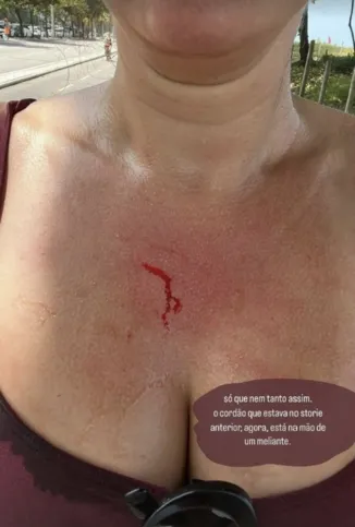 Ela mostrou o ferimento