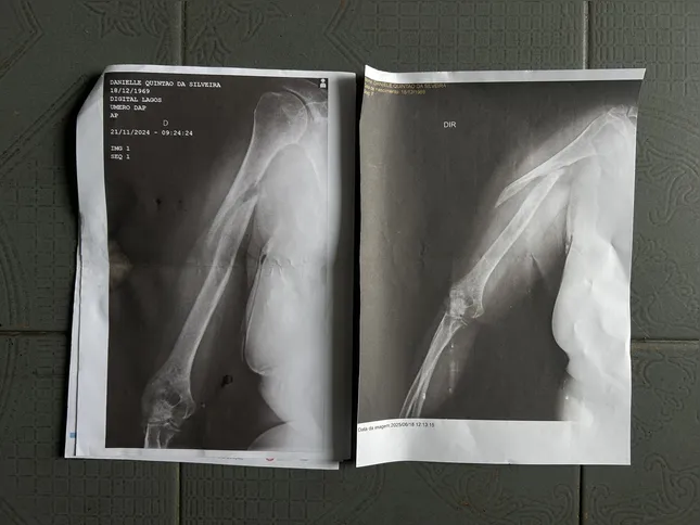 volução das radiografias da paciente: à esquerda, uma das primeiras; à direita, uma das mais recentes