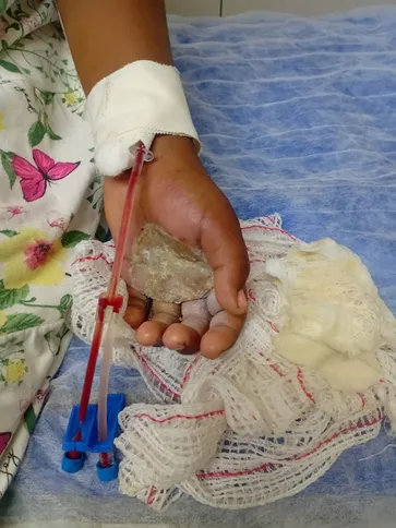 Mulher obrigou filha a segurar ovo cozido em ponto de fervura