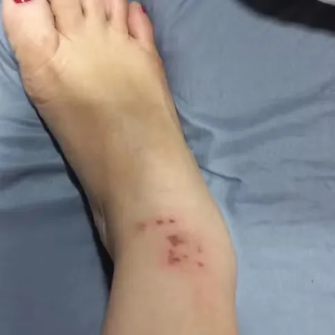Agressora publicou foto do tornozelo ferido