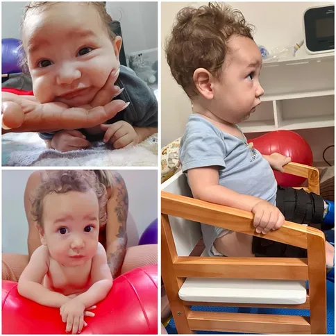 Sem tratamento precoce, a progressão da AME tipo 1 pode comprometer funções básicas